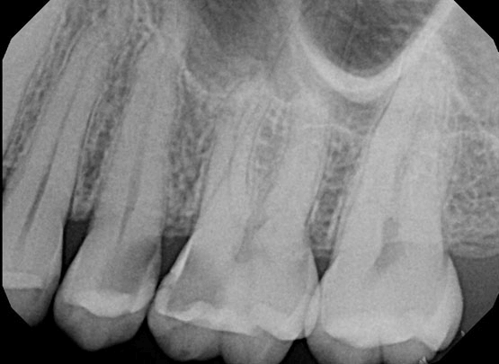 Root Canal Before
