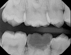 BW of 46 with pulp polyp