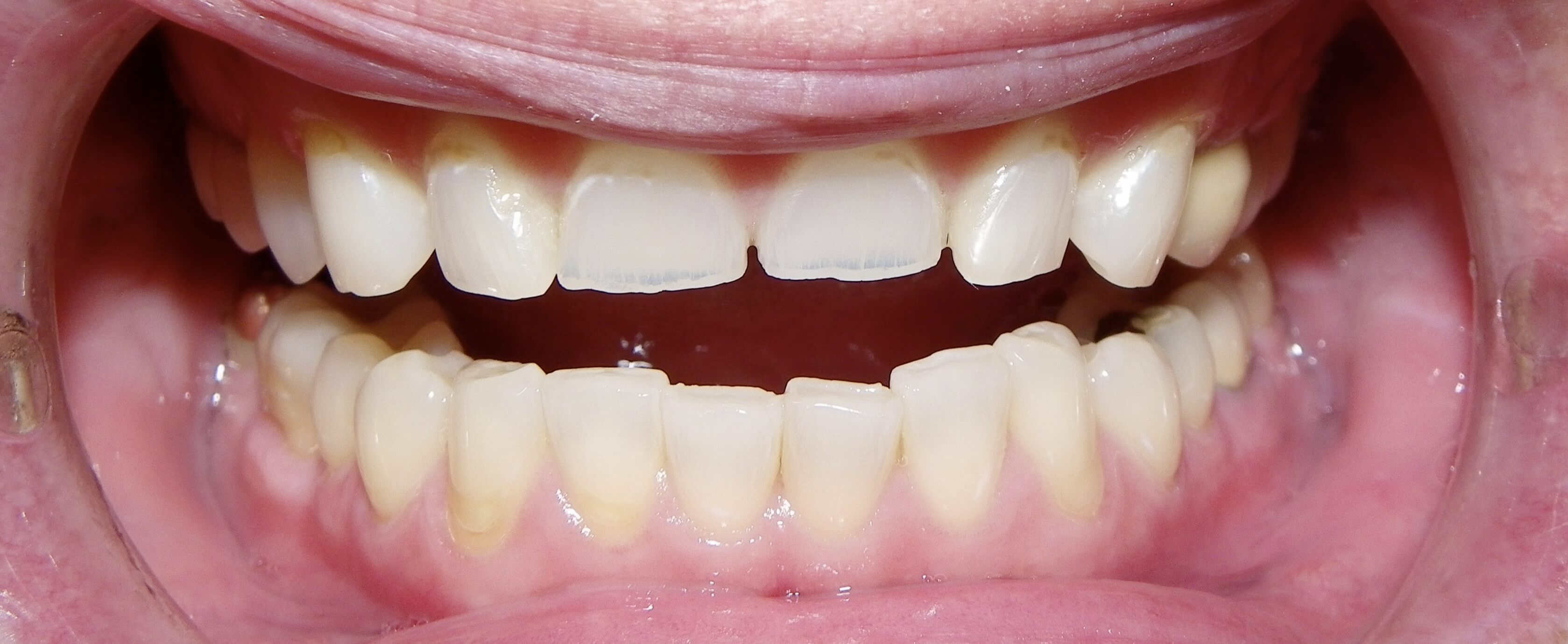 Step By Step Dental Filling Procedure - Dr. Elston Wong Dentistry